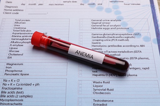 Anemia em pacientes com colite ulcerativa ou retocolite ulcerativa (RCU)