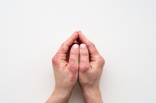 Eczema