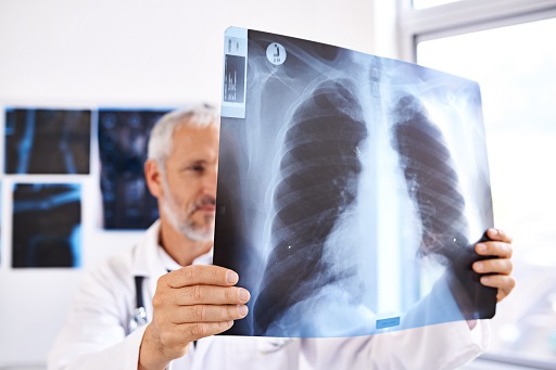 Edema Pulmonar