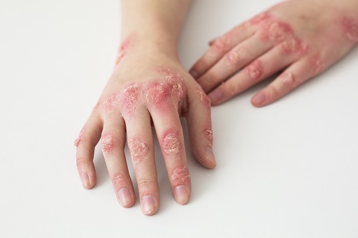 Erupção psoriásica