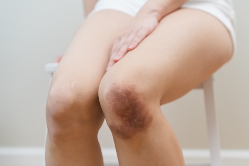 Hematoma