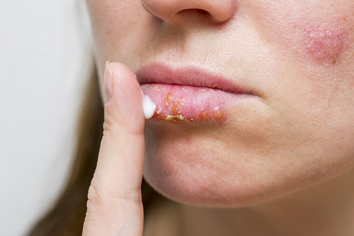 Herpes simples