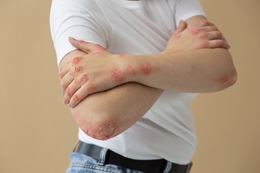 Herpes zoster