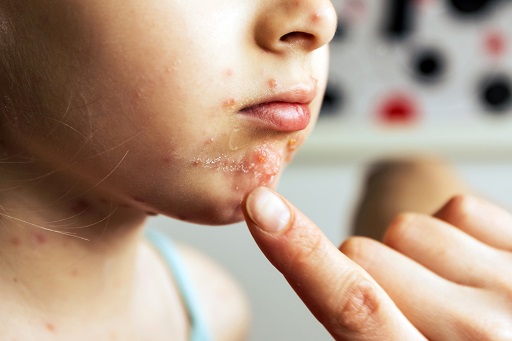 Impetigo