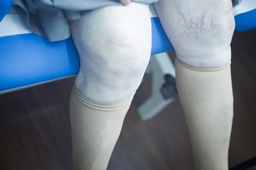 Edema de membros inferiores