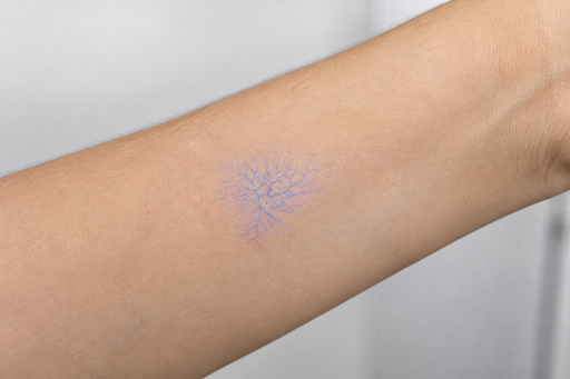 Telangiectasia