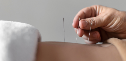 Acupuntura